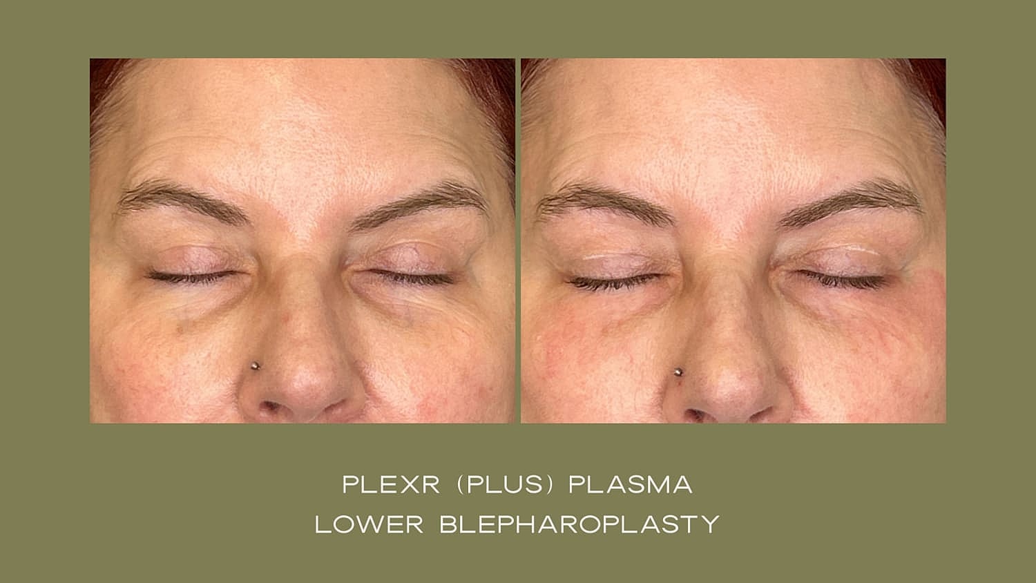 Plexr Before & After